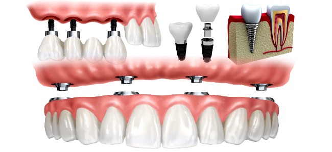 Dental Procedure Videos